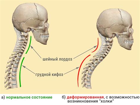 Влияние плохой осанки на развитие нивелированного шейного лордоза