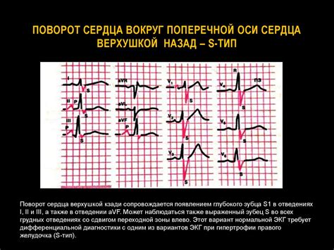 Влияние поворота сердца верхушкой кзади на ЭКГ на здоровье