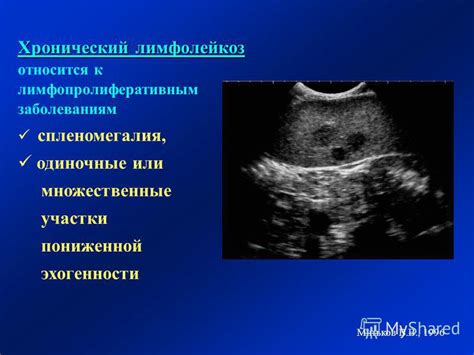 Влияние повышения эхогенности селезенки на организм