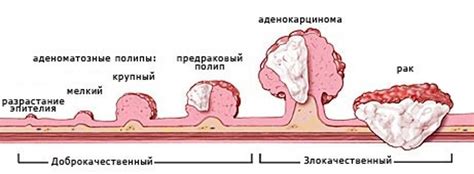 Влияние рака кишечника на распад опухоли