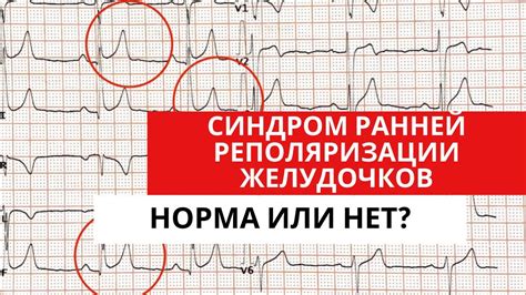 Влияние синдрома ранней реполяризации желудочков на сердечную деятельность