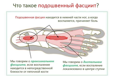 Влияние фактурной подошвы на безопасность при ходьбе