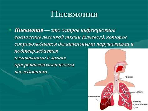 Внегоспитальная пневмония: определение и причины