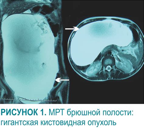 Внеорганная киста брюшной полости