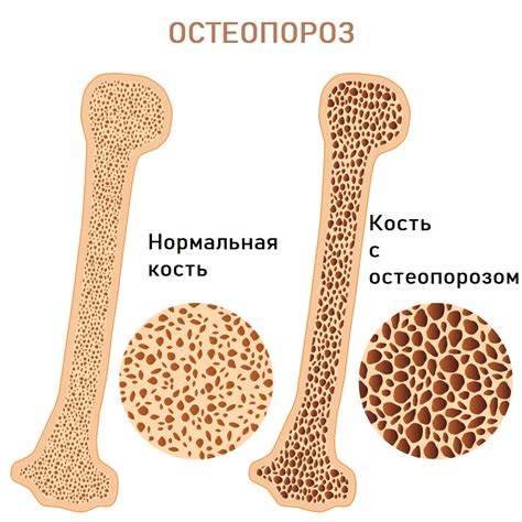 Возможность развития остеопороза