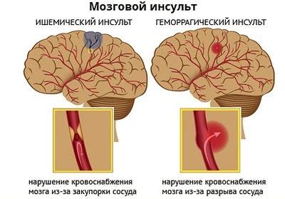 Возможные нарушения работы гипоталамуса и их последствия