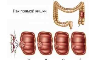 Возможные осложнения геморроя 3-ей степени