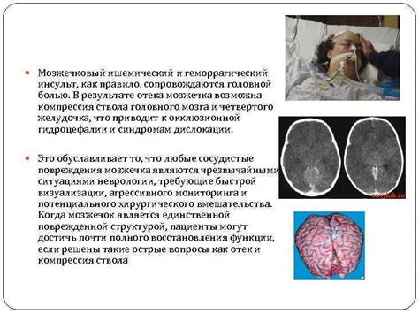 Возможные осложнения отека мозжечка