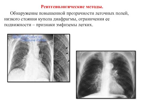 Возможные осложнения повышенной прозрачности легочных полей