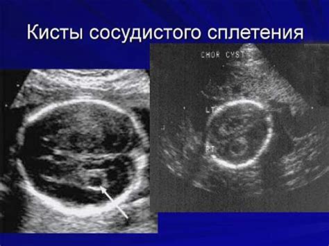 Возможные осложнения после лечения кисты сосудистого сплетения справа