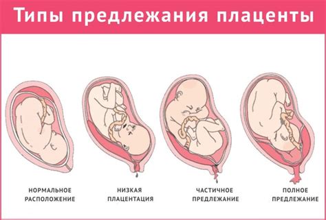 Возможные осложнения при центральном прикреплении плаценты