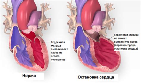 Возможные последствия ротации сердца