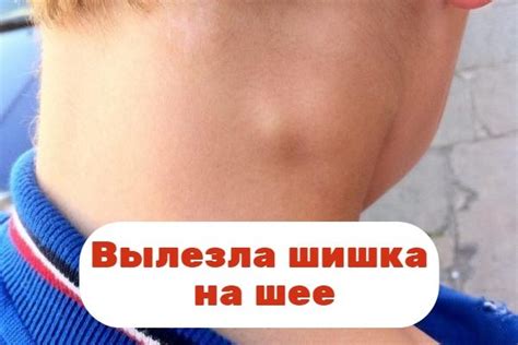 Возможные причины появления шишки на шее