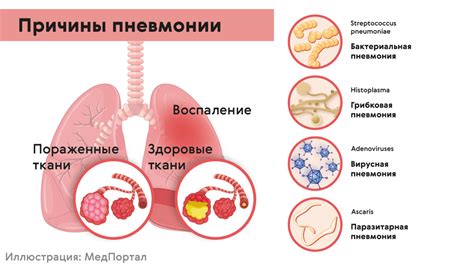 Возможные причины развития неполного регресса пневмонии: