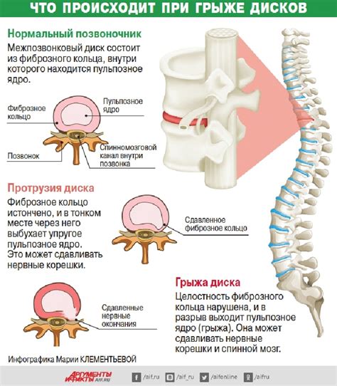 Возможные проблемы с межпозвоночным диском