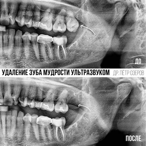 Возможные события в жизни, связанные с сновидениями об удалении болезненного зуба