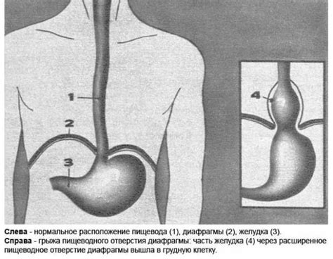 Возникновение хиатуса пищеводного отверстия