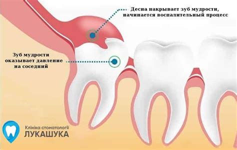 Воспаление зуба: симптомы и последствия