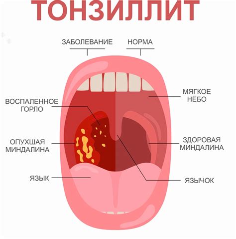 Воспаление миндалин