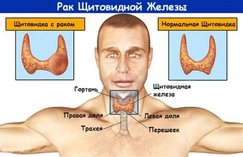 Воспаление щитовидной железы: симптомы и причины