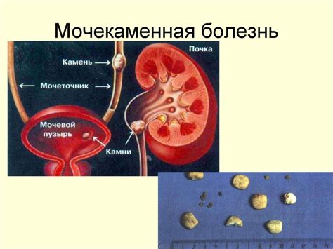 Воспалительные заболевания мочевыводящих путей: связь с болями при мочеиспускании