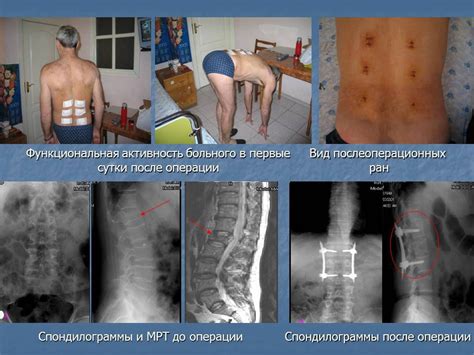 Восстановление и реабилитация после плановой операции по удалению