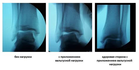 Восстановление после лечения некроза голеностопного сустава