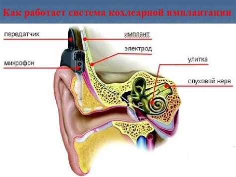 Восстановление слуха после кохлеарной имплантации