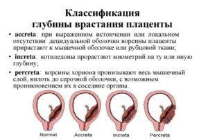 Врастание плаценты: основные симптомы