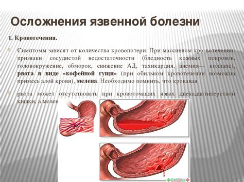 Вредные последствия зарубцевания язвы желудка