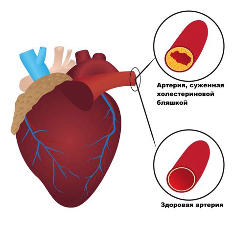 Вред повышенного холестерина