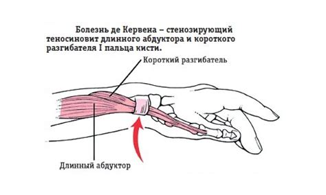 Вред повышенной нагрузки на руки