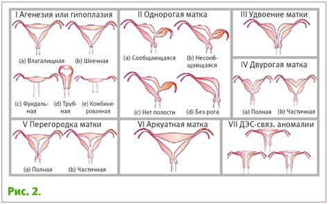 Врожденные аномалии матки