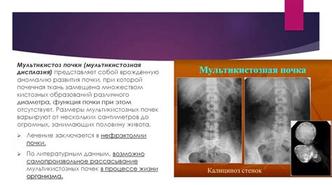 Врожденные аномалии почек, вызывающие увеличение объема почечных чашечек у женщин