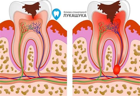 Выпадение зуба: причины, последствия и способы лечения