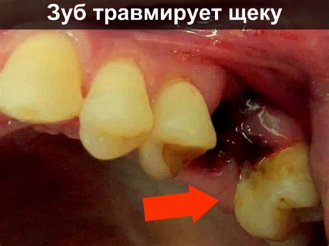 Вырванный зуб: причины, последствия и лечение