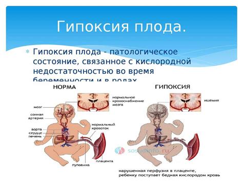 В чем состоит гипоксия плода?