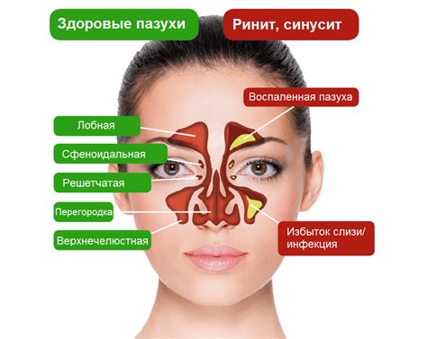 Гайморит: причины и симптомы