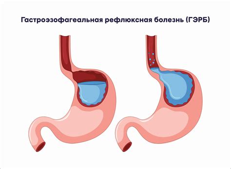 Гастроэзофагеальная рефлюксная болезнь