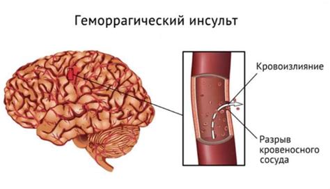 Геморрагический инсульт головного мозга