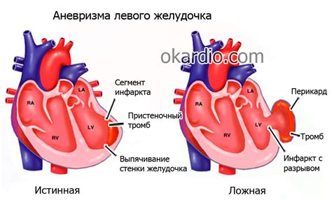 Генетические причины разрыва сердца