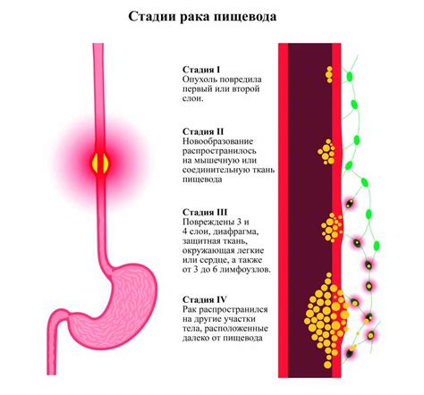 Гетеротопия слизистой пищевода