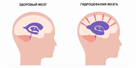 Гидроцефалия головного мозга: причины, симптомы и лечение