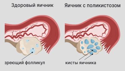 Гиперплазия эндометрия: симптомы и признаки