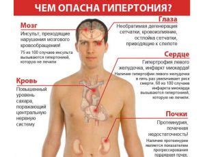 Гипертония: определение и симптомы