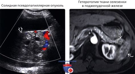 Гиподенсивное образование в поджелудочной железе