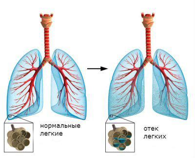 Гипоксемия: определение, причины, симптомы