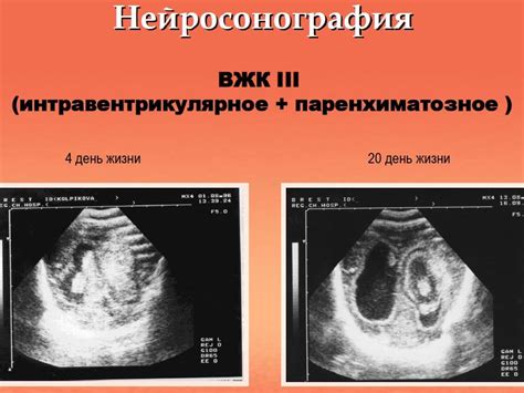 Гипоксическое поражение головного мозга у новорожденных