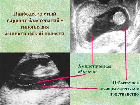 Гипоплазия амниотической полости