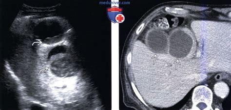 Гипоплазия желчного пузыря у ребенка
